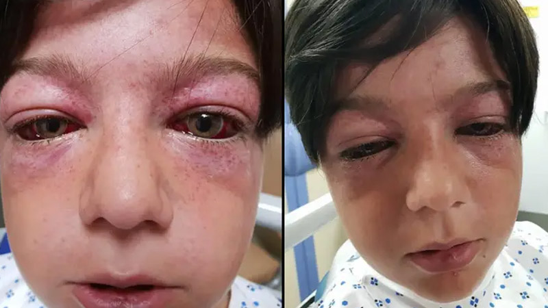 A playground fad leaves an 11-year-old boy “looking like an alien” – his mother issues a warning to all parents